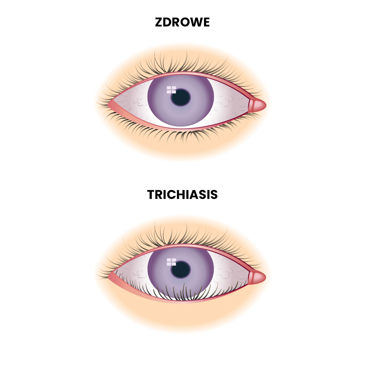 trichiasis